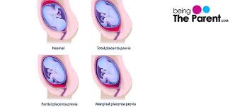 Characterization of these types depends on how much the placement of the placenta interferes with the cervical opening. Placenta Previa Symptoms Causes Treatment Being The Parent