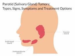 parotid salivary gland tumors types