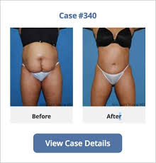 top rated tummy tuck surgery