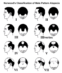 Classification Of Hair Loss In Men