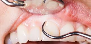 gum swelling after root c root