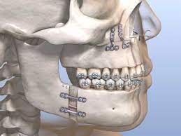 what is orthognathic surgery head