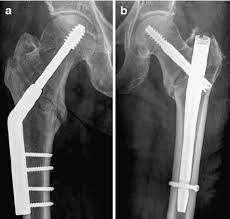 dynamic hip system dhs b gamma