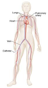 These carry deoxygenated blood back to the heart, and they increase in size as they get closer to the heart. Pulmonary Angiography Saint Luke S Health System