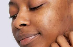 how to get rid of acne scars fast with