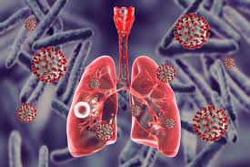 Tuberculosis definition tuberculosis (tb) is a potentially fatal contagious disease that can affect it is caused by a bacterial microorganism, the tubercle bacillus or mycobacterium tuberculosis. Tuberculosis News Articles Tb Drugs Treatment Studies Tests