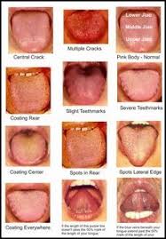 Tongue Diagnosis Is Another Cornerstone Of Chinese Medicine