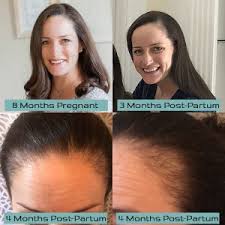 When is hair loss the sign of a problem? Hear From A Patient Laura D Shares Her Experience Medi Tresse Boston