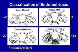 Maybe you would like to learn more about one of these? Stages Classification Of Endometriosis Stage 1 Stage 2 Stage 3 Stage 4 Endo I H Endometriosis Stages Endometriosis And Infertility Infertility Awareness