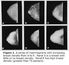 Breast Density Inform Inconsistency Delivers Confusion