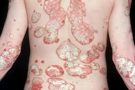 Psoriasis may look different for different skin types. Your Psoriasis Is It Mild Moderate Or Severe