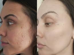 how i got rid of my acne scars from