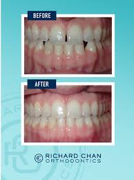 Straight teeth are healthy and look great! Common Teeth Problems An Orthodontist Can Fix Richard Chan Orthodontics