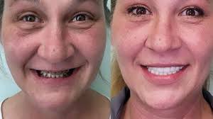 full mouth dental implants lorton