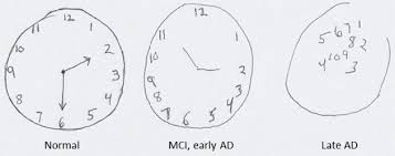 clock drawing and trump s cognitive test