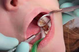 Dziura w zębie – czym jest, leczenie, zapobieganie | WP abcZdrowie