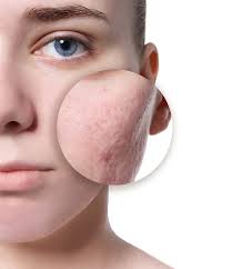 acne scar treatment in c gables fl