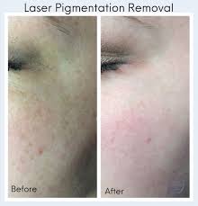 laser pigmentation removal in raleigh