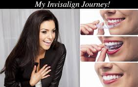 voucher off invisalign with clearbraces ie