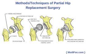 partial hip replacement surgery