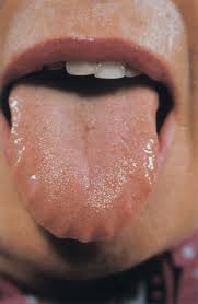 the tongue in clinical diagnosis