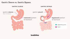 gastric sleeve vs gastric byp