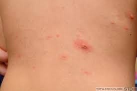 Usually, they appear as small raised bumps on the skin. Mild Herpes The Symptoms Of Mild Genital Herpes Or By Ivan Kostenko Medium