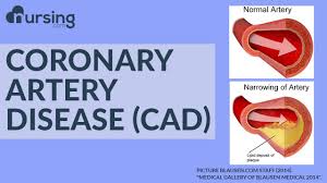 what is coronary artery disease and