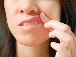 blister on lip causes symptoms