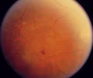 Image result for icd 10 code for retinal pigment epithelium changes