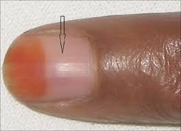 surgical nail avulsion