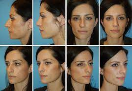 virtual rhinoplasty tool face touch