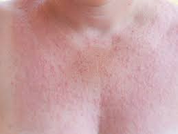 skin allergies symptoms treatment