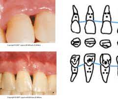 periodontal charting ppt flashcards