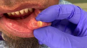 mucocele snot bubble removal on