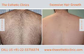 excessive hair growth removal treatment