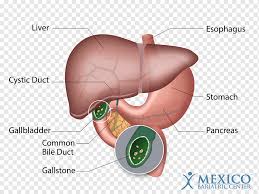 gallstone png images pngwing