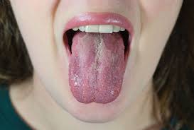 thrush from inhaler symptoms causes