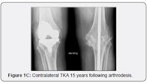 knee arthrodesis the fate of the
