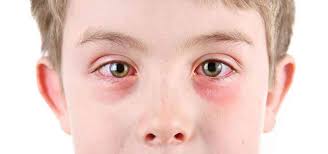 eye allergies cause symptoms