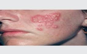herpes simplex signs and symptoms dr