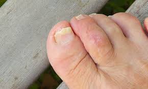 thicker toenails croydon total footcare
