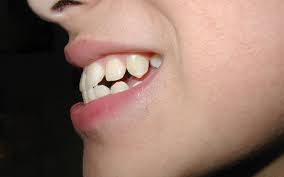 They are most effective with underbites caused by dental issues, but when used in conjunction with rubber bands they can also help align the jaws. Braces For An Overbite How They Fix An Over Or Underbite