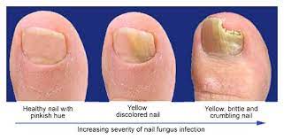 how did i get toenail fungus inkfree