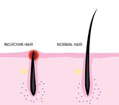 how to get rid of ingrown hair
