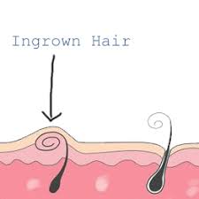 ingrown hairs on your line