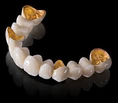 Hot Item New Perfect Dental Porcelain Fused To Metal Pfm Crown