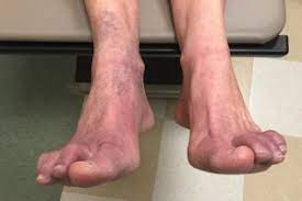 purple feet 7 cal reasons you