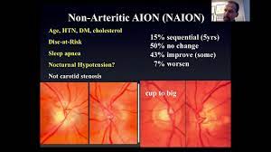 Optic neuropathy, anterior ischemic, susceptibility to 56. Optic Neuropathy Part 2 Ischemic Compressive Hereditary Youtube