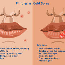 is it a cold sore or pimple